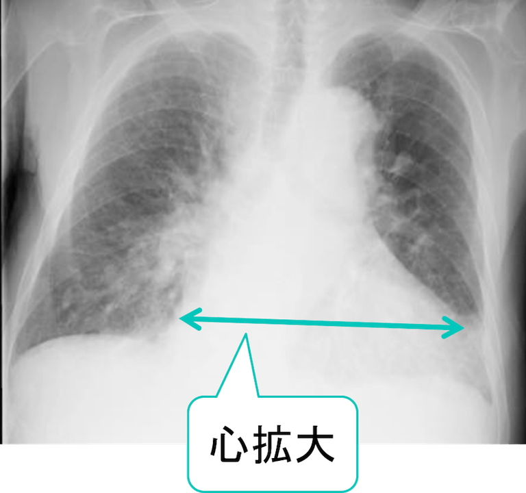 肺水腫や心不全の胸部レントゲンやCT画像診断のポイントは？